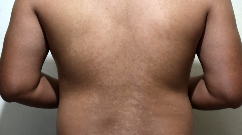 Pityriasis versicolor - kožné škvrny